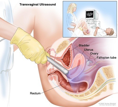 Những điều cần biết về siêu âm đầu dò âm đạo