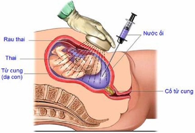 Những điều cần biết về sinh thiết nhau gai