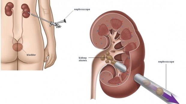 Những điều cần biết về sỏi đường tiết niệu