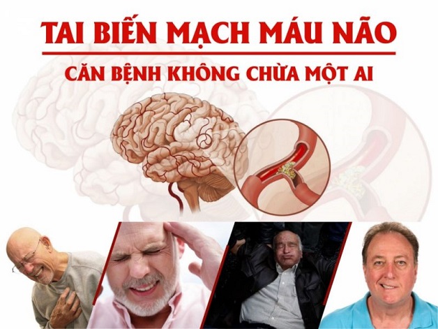 Những điều cần biết về tai biến mạch máu não để phòng tránh hiệu quả