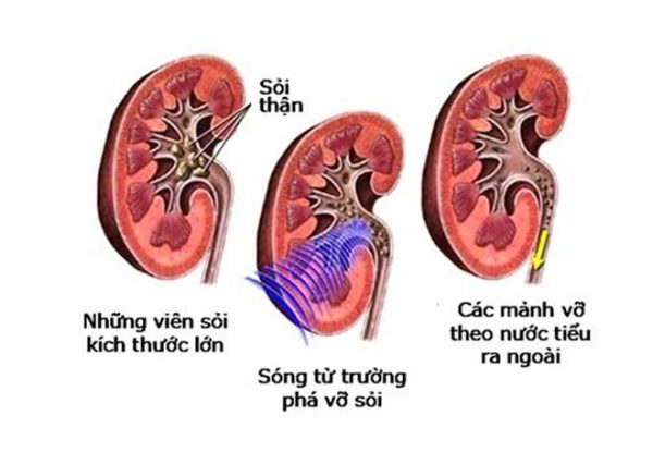 Những điều cần biết về tán sỏi ngoài cơ thể