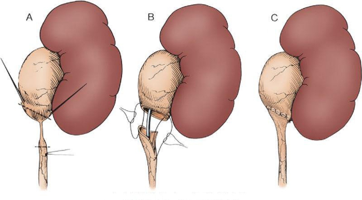 Những điều cần biết về tạo hình khúc nối bể thận niệu quản