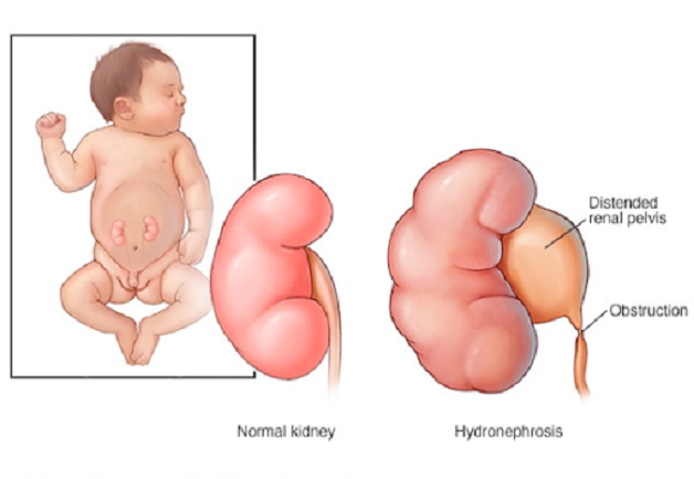 Những điều cần biết về tạo hình khúc nối bể thận niệu quản