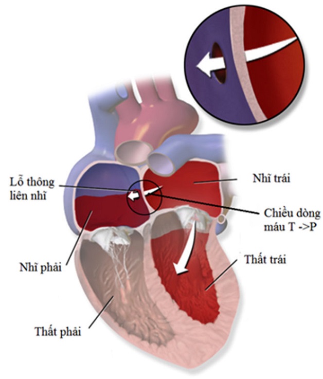 Những điều cần biết về thông liên nhĩ kiểu lỗ thứ hai