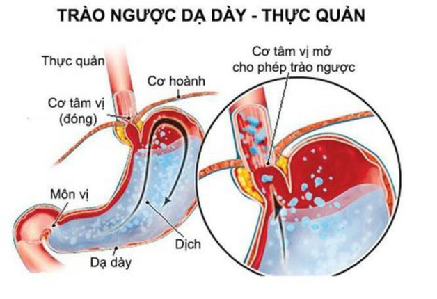 Những điều cần biết về trào ngực dạ dày thực quản ở trẻ