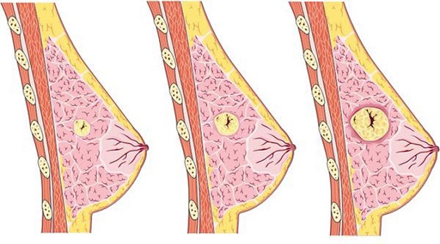 Những điều cần biết về u nang tuyến vú lành tính