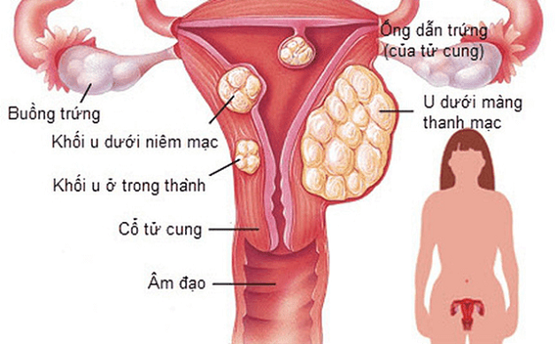 Những điều cần biết về u xơ tử cung và thai nghén