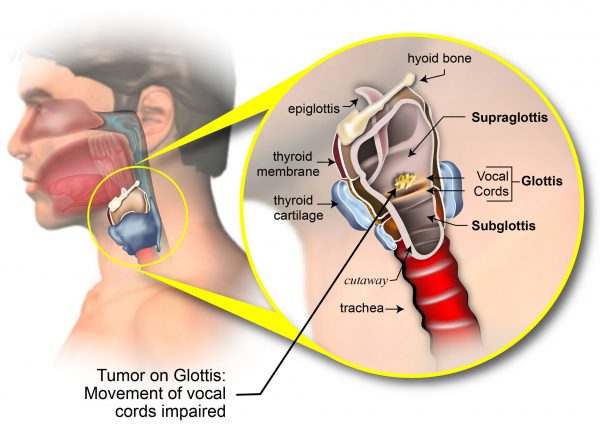 Những điều CẦN BIẾT về Ung thư thanh quản giai đoạn 2