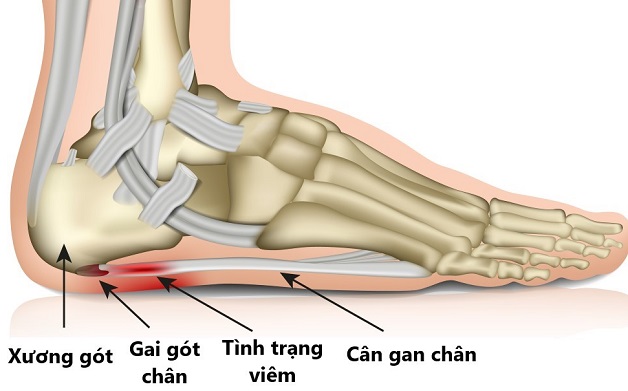 Những điều cần biết về viêm cân gan bàn chân