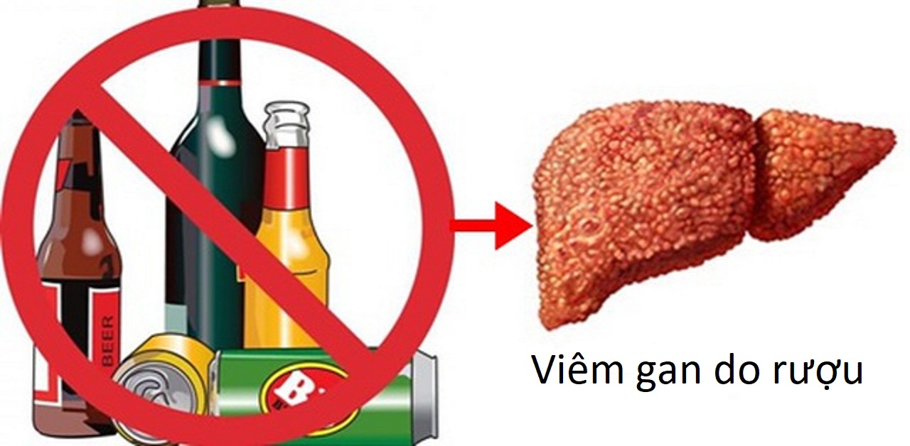 Những điều cần biết về viêm gan do rượu