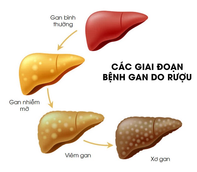 Những điều cần biết về viêm gan do rượu