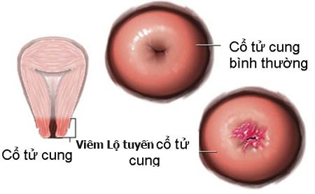 Những điều cần biết về viêm lộ tuyến cổ tử cung