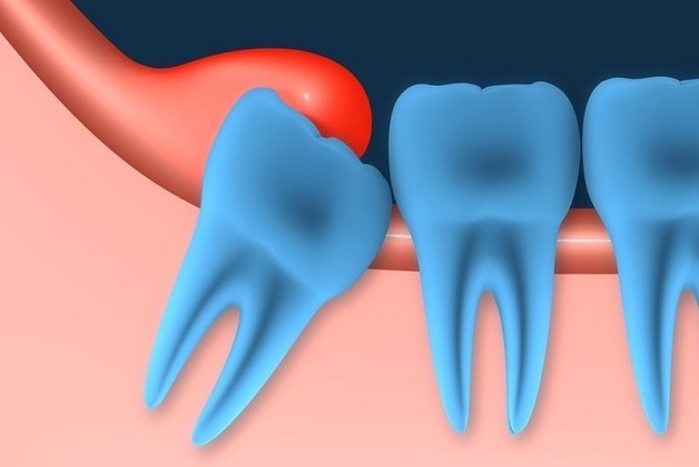 Những điều cần biết về viêm lợi trùm răng khôn