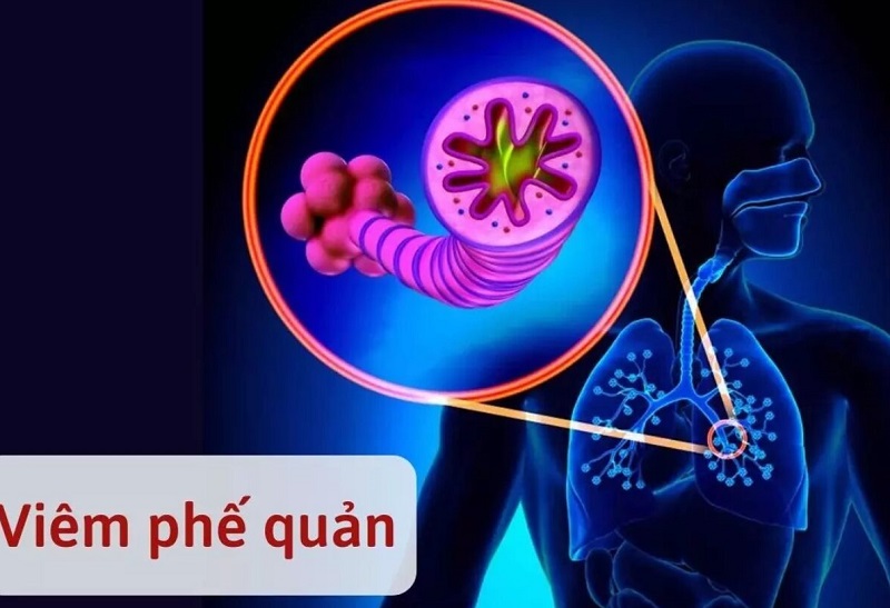 Những điều cần biết về viêm phế quản cấp j20