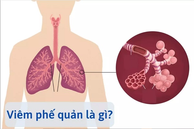 Những điều cần biết về viêm phế quản cấp