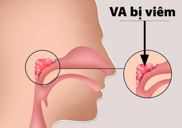 Những điều cần biết về Viêm VA ở trẻ