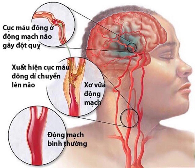 Những điều cần biết về xơ vữa động mạch cảnh