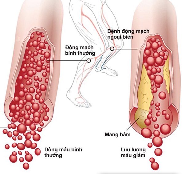 Những điều cần biết về xơ vữa động mạch chi dưới