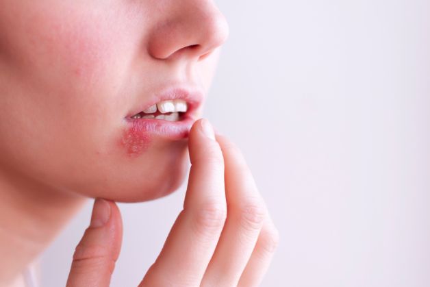 Những điều cần lưu ý về bệnh Herpes ở môi