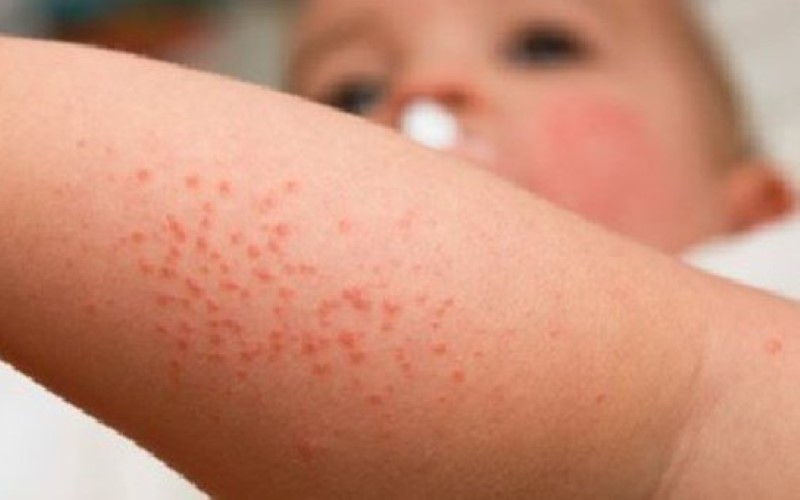 Những điều cần lưu ý về bệnh herpes ở trẻ em