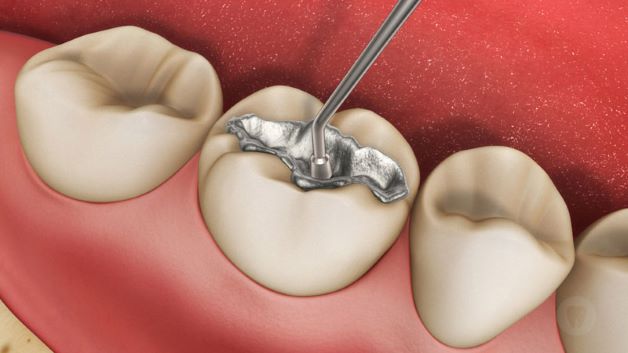 Những điều cần lưu ý về chăm sóc sau hàn răng sâu