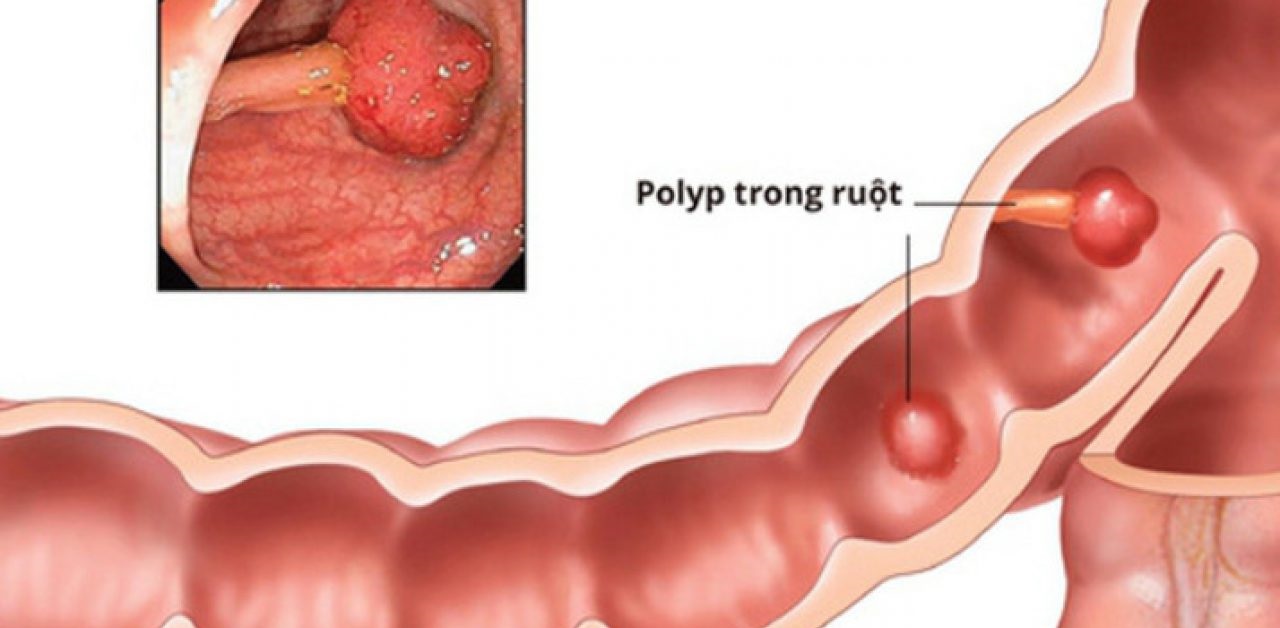 Những điều cần phải biết về polyp đại trực tràng