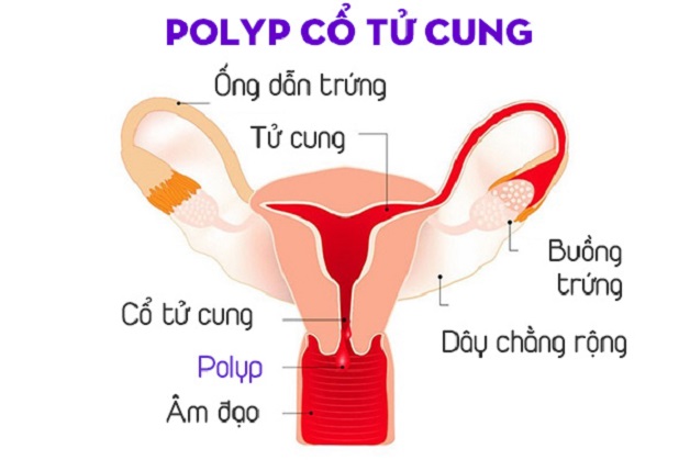 Những điều chị em nên biết về quy trình đốt polyp cổ tử cung