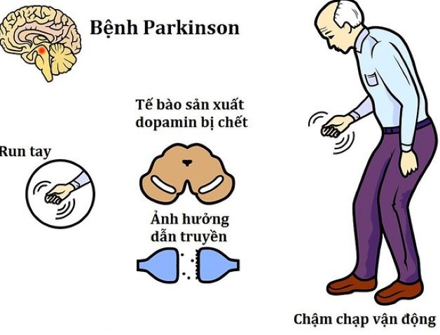 Những điều nên làm trong quá trình điều trị bệnh parkinson