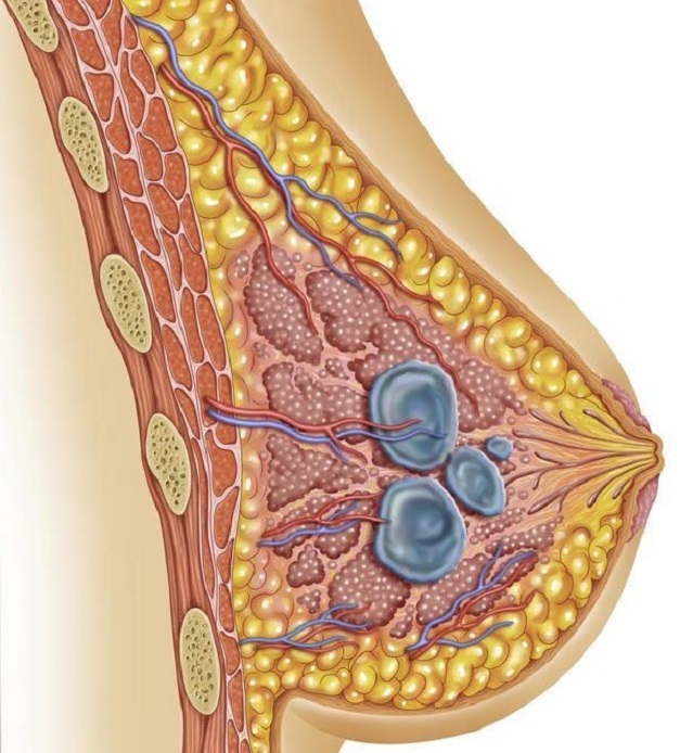 Những điều về u nang tuyến vú mà bạn cần biết rõ