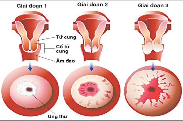 Những đối tượng cần tầm soát ung thư cổ tử cung