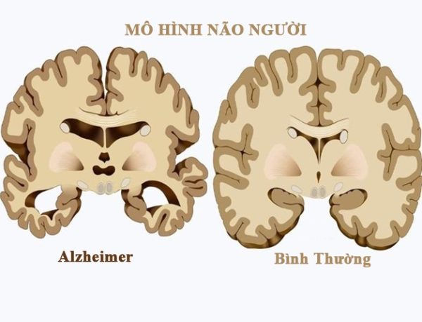 Những đối tượng có thể bị alzheimer và cách phòng ngừa bệnh