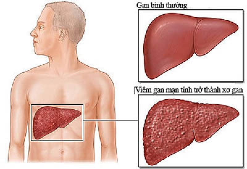 Những giai đoạn của bệnh xơ gan