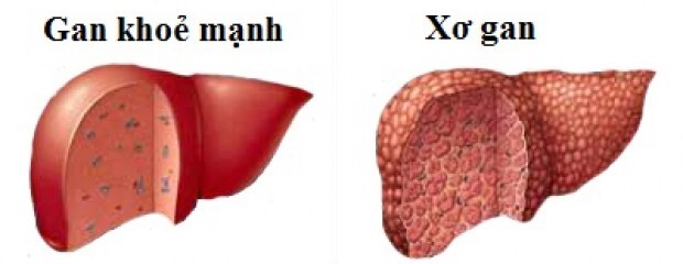 Những giai đoạn của bệnh xơ gan