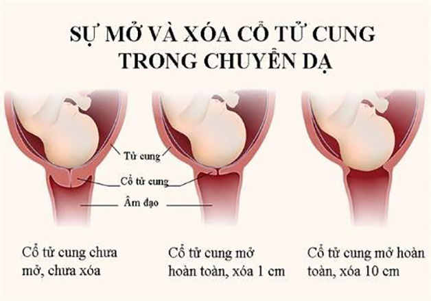 Những giai đoạn mẹ cần được chăm sóc chuyển dạ đẻ thường