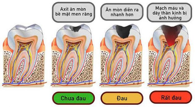 Những hậu quả có thể gặp phải khi răng vĩnh viễn bị sâu