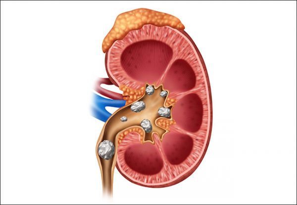 Những hiểu lầm thường gặp về bệnh sỏi thận