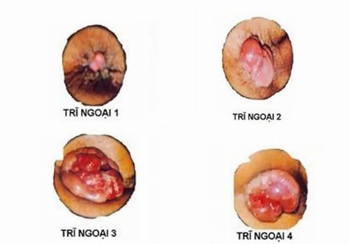 Những hình ảnh về bệnh trĩ ngoại