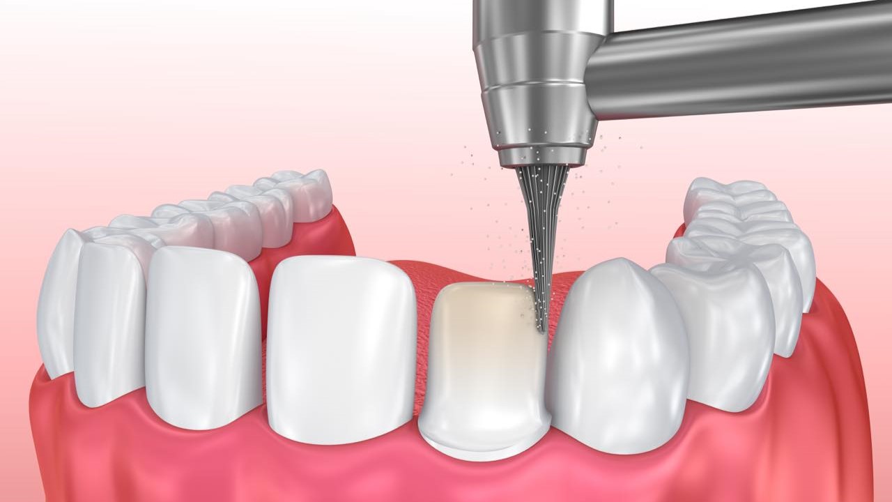 Những lời khuyên về bọc răng sứ nguyên hàm