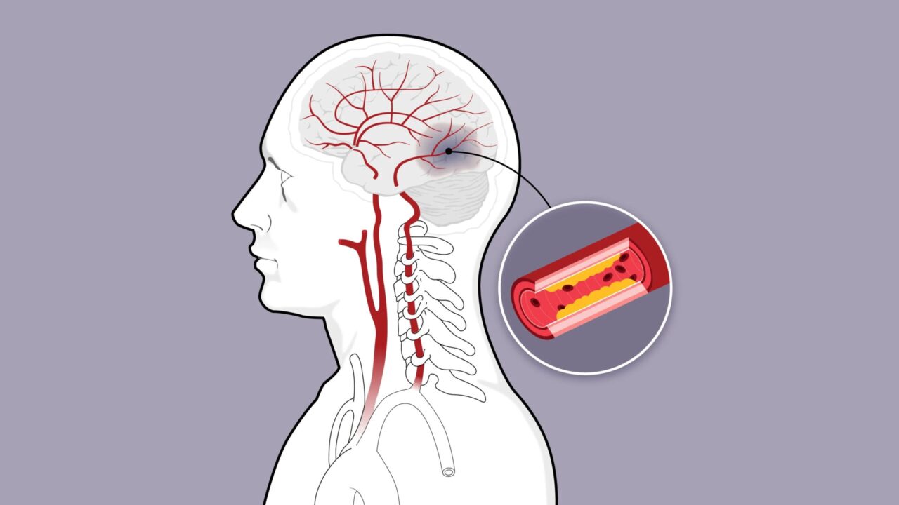 Những lưu ý đột quỵ có thể tái phát