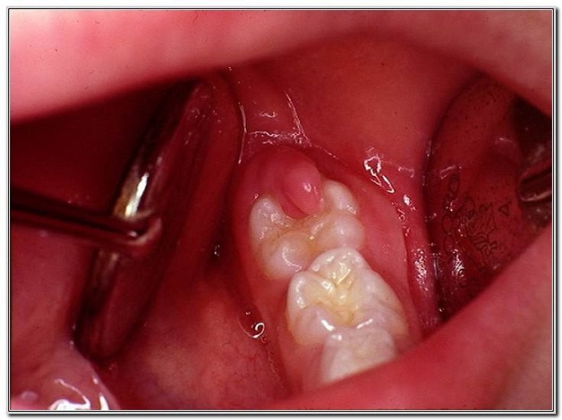 Những lưu ý khi nhổ răng số 8 để tránh biến chứng 