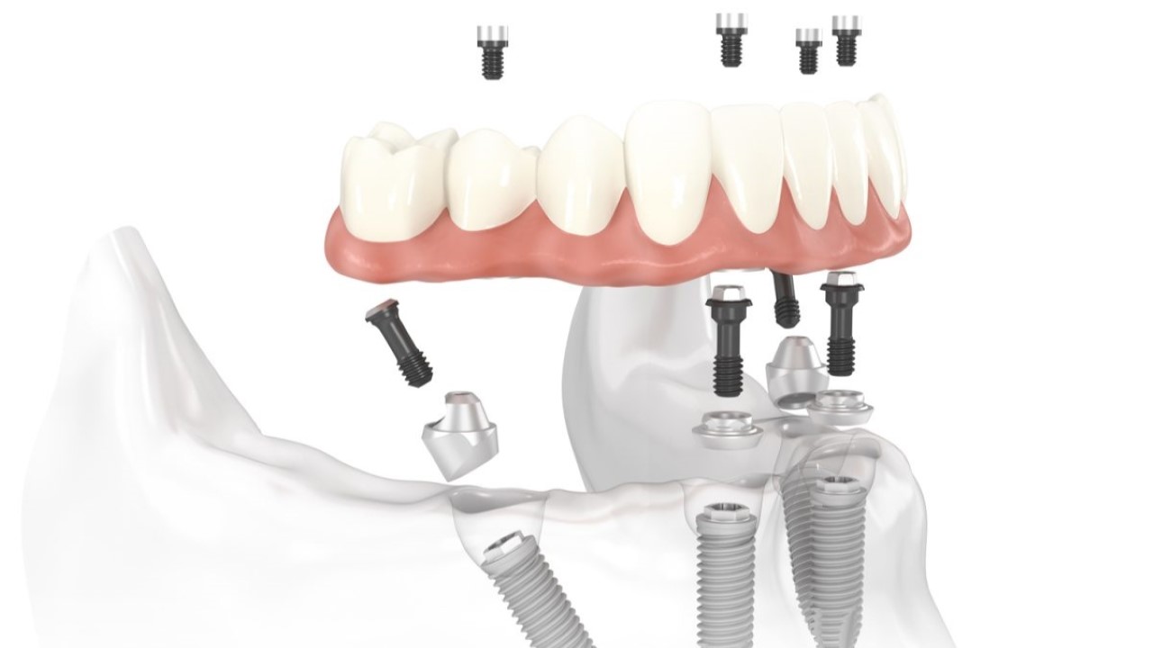 Những lưu ý khi thực hiện kỹ thuật trồng răng Implant