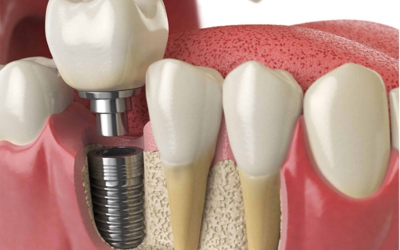 Những lưu ý khi thực hiện kỹ thuật trồng răng Implant