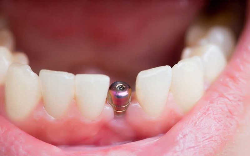 Những lưu ý khi thực hiện kỹ thuật trồng răng Implant