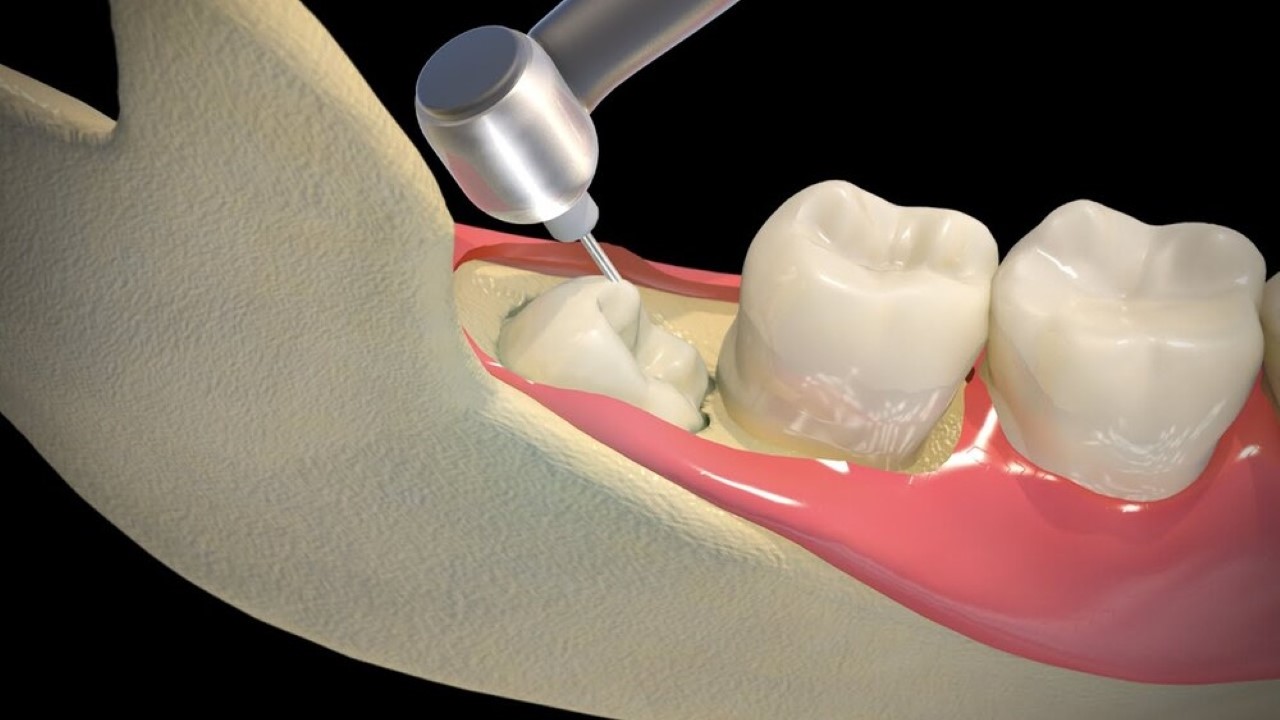 Những lưu ý quan trọng về quy trình nhổ răng số 8