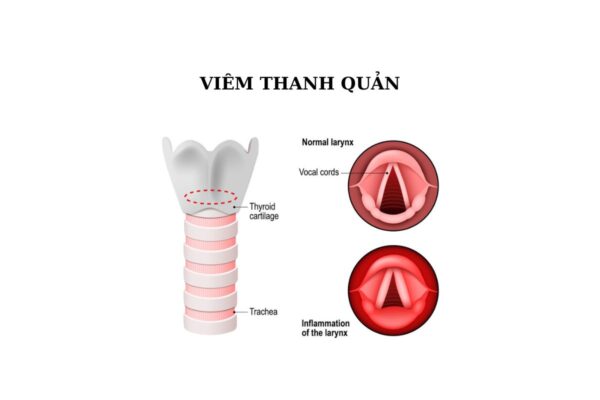 Những lưu ý trong điều trị viêm thanh quản