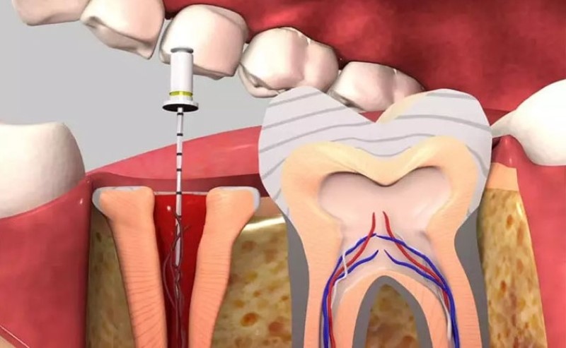 Những lý do bị sâu răng vào tủy