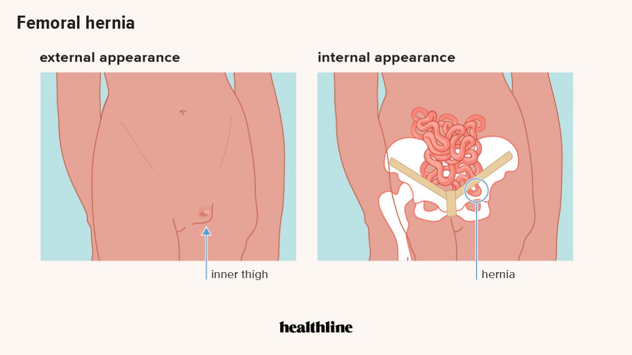 Những lý do không nên trì hoãn điều trị thoát vị