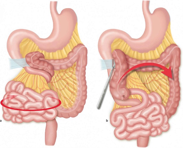 Những lý do không nên trì hoãn điều trị thoát vị