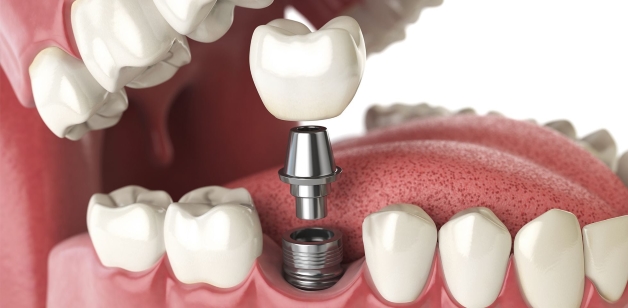 Những nguy cơ từ trồng răng Implant giá rẻ