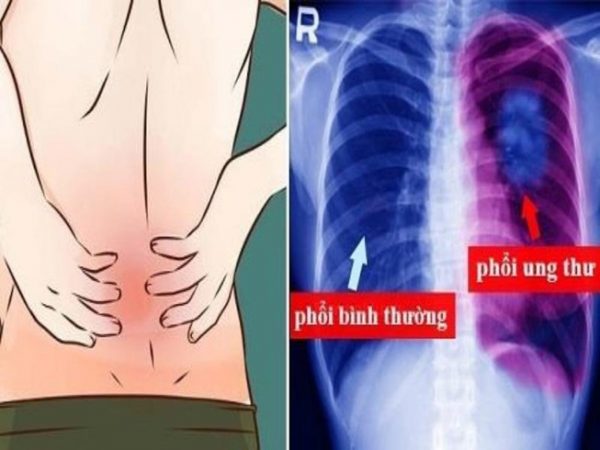 Những nguyên nhân gây đau lưng ở nam giới ít người nghĩ đến